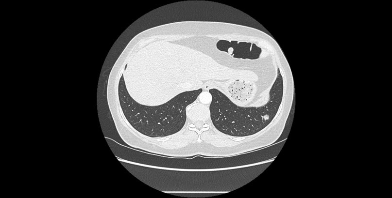 Coupe parenchymateuse du TDM thoracique sans injection