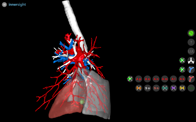 Reconstruction 3D. Analyse anatomique fine et navigation peropératoire 