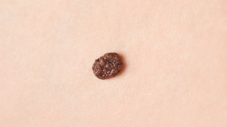 Grain de beauté et cancer : comment savoir si un grain de beauté est dangereux ? Mélanome. Grain de beauté irrégulier boursoufflé marron et noir.