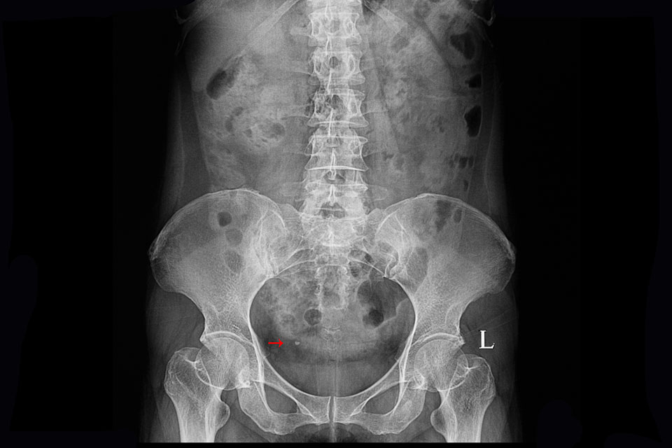 hematurie