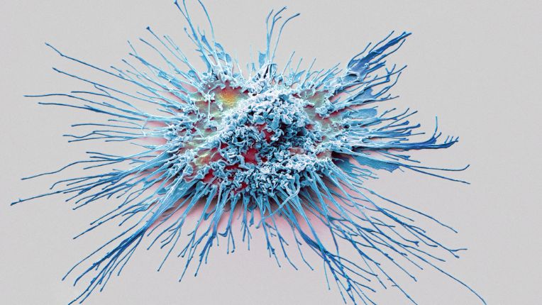 Histiocytose : image d'une cellule dendritique en couleur obtenue avec un micrographe électronique à balayage.