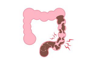 Illustration : estomac bloqué de selles 