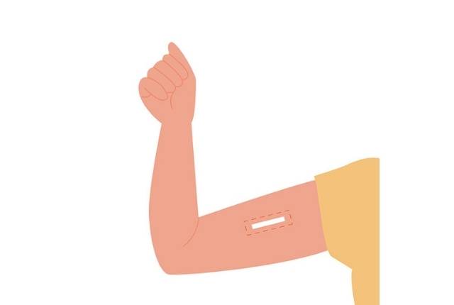 implant contraceptif pose