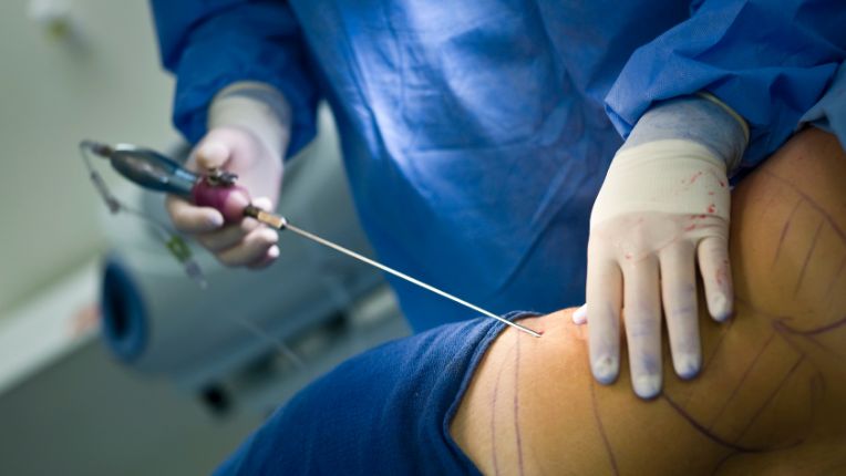 Lipœdème : intervention pour liposuccion, un des traitements possibles du lipœdème .