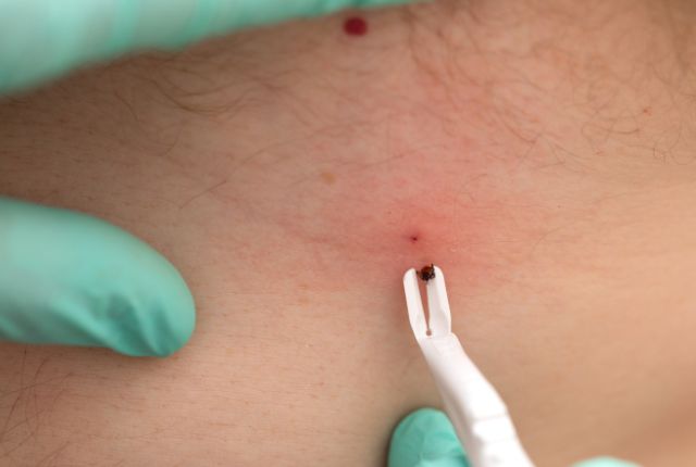 Maladie de Lyme : utilisation d'un tire-tique pour retirer une tique attachée à la peau.
