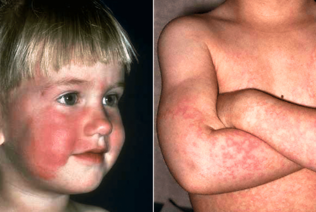 Cinquième maladie - image d'un jeune enfant blond aux joues rouges, infecte par la cinquieme maladie aussi appelée megalerytheme epidermique - Elsan