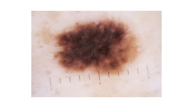 Quels sont les différents types de cancer de la peau ? Image d'un mélanome superficiel extensif. Tache marron agrandie s'étendant sur plus de 6 mm.
