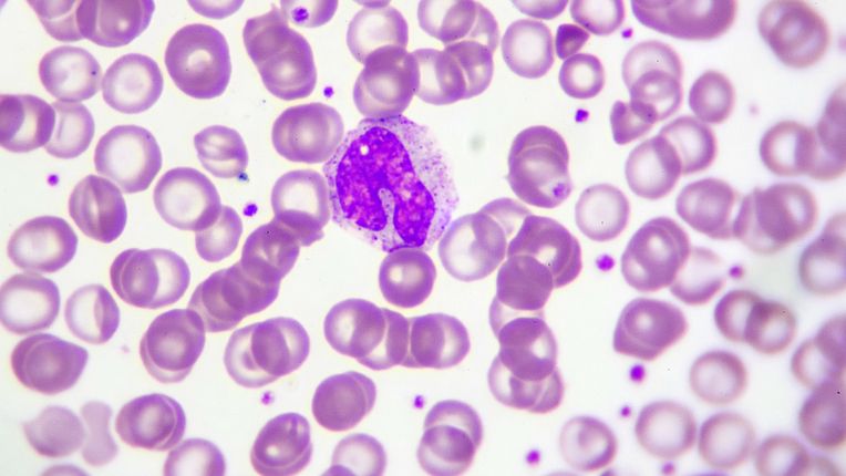 Monocytes : définition, haut, bas, symptômes, prise de sang. Image de monocytes dans un prélèvement au microscope.