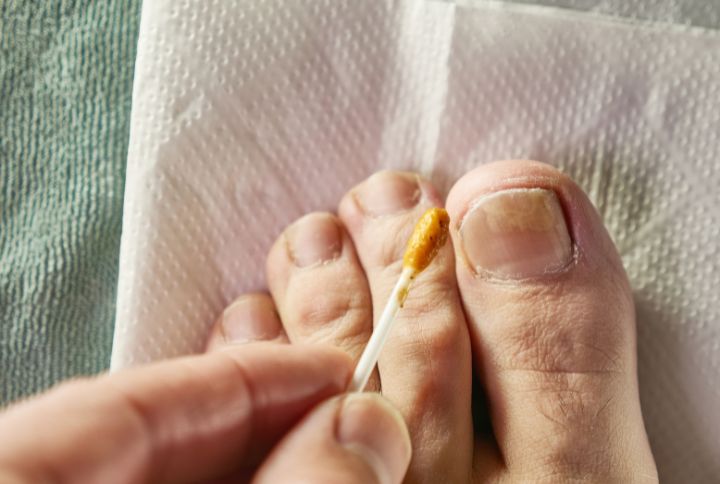 Mycose du pied : un homme soigne l'ongle de son gros orteil en le badigeonnant avec un coton tige.