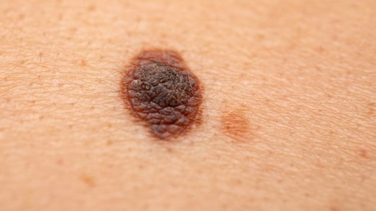 Grain de beauté et cancer : comment savoir si un grain de beauté est dangereux ? Nevis dangereux sur la peau. Grain de beauté noir granuleux à l'aspect irrégulier.