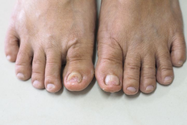 Onychomycose : image de deux pieds dont les orteils sont touchés par une mycose d'ongle. Ongles entamés, jaunes, friables.