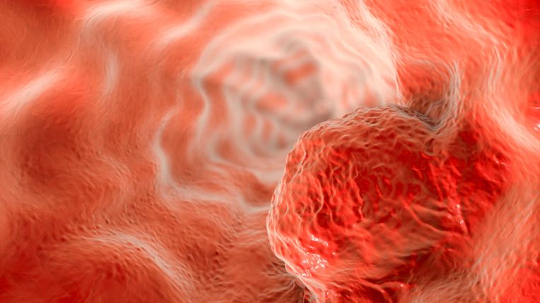 Opération de l’œsophage par robot à Agen. Figuration virtuelle d'une tumeur cancéreuse située dans l’œsophage.