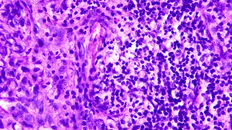 Opération de l’adénocarcinome par robot à Toulouse. Image au microscope d'un adénocarcinome de la prostate.