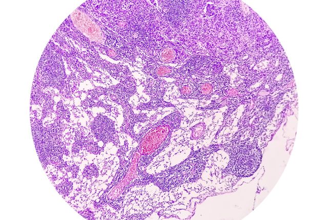 Opération de l’adénocarcinome par robot à Valenciennes. Image d'un adénocarcinome de l'estomac au microscope.