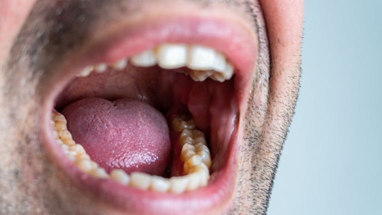 Opération de la bouche par robot à Toulouse. Image de la bouche ouverte d'un homme.
