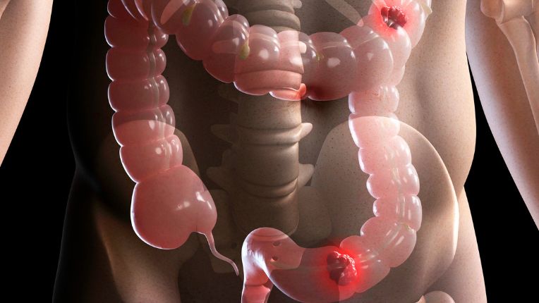 Opération de l’intestin par robot à Montauban. Image de synthèse de l'intestin dans le corps humain touché par des zones cancéreuses.