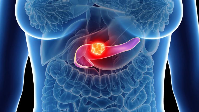opération pancréas par robot Montauban. Image synthétique en 3 D d'un corps humain situant le pancréas au sein de l'abdomen.