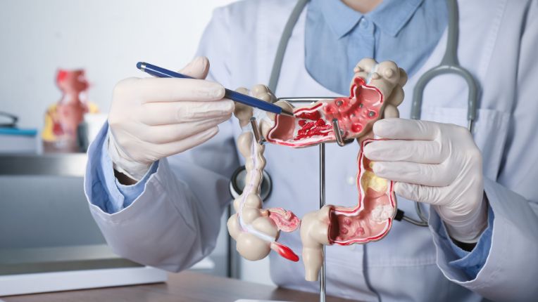 Opération du côlon par robot à Toulouse. Un ou une gastroentérologue montre à quoi ressemble le côlon sur une maquette du système digestif humain.