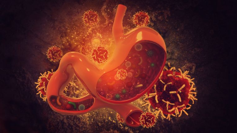 Opération de l'estomac par robot à Valenciennes. Image de synthèse figurant l'estomac et des cellules cancéreuses.