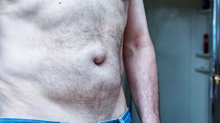 Operation hernie par robot Brest. Image d'une hernie ombilicale, renflement du nombril, sur le ventre d'un homme.