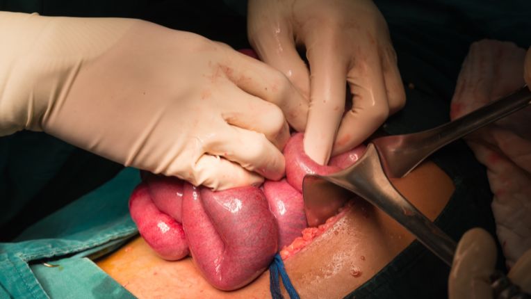 Opération de l’intestin par robot à Agen. Photo d'intestin grêle au cours d'une opération chirurgicale.