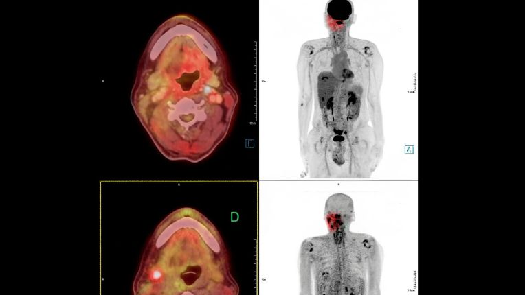 Opération du nasopharynx par robot à Toulouse. Cliché d'imagerie médicale montrant un carcinome du nasopharynx.
