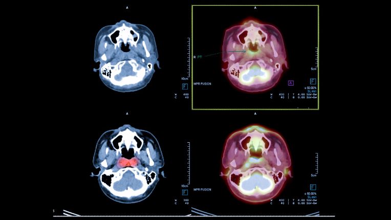 Opération du nasopharynx par robot à Valenciennes. Images d'un carcinome du nasopharynx vue sur un PET scan du cerveau.