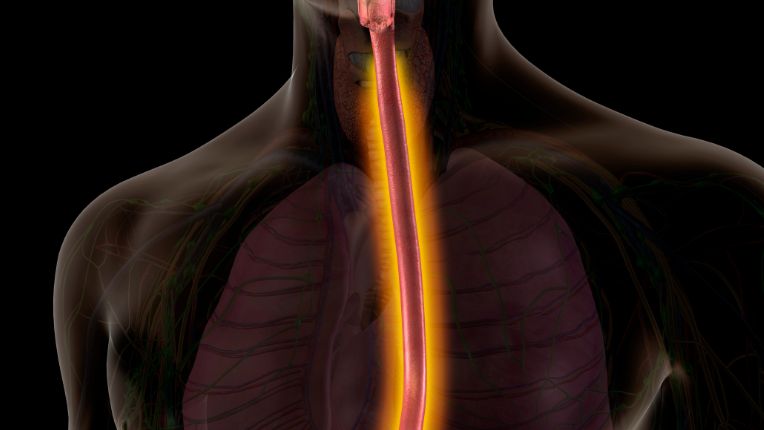 Opération de l’œsophage par robot à Valenciennes. L'emplacement de l'œsophage souligné par un trait rouge et jaune sur l'image d'un torse d'homme.