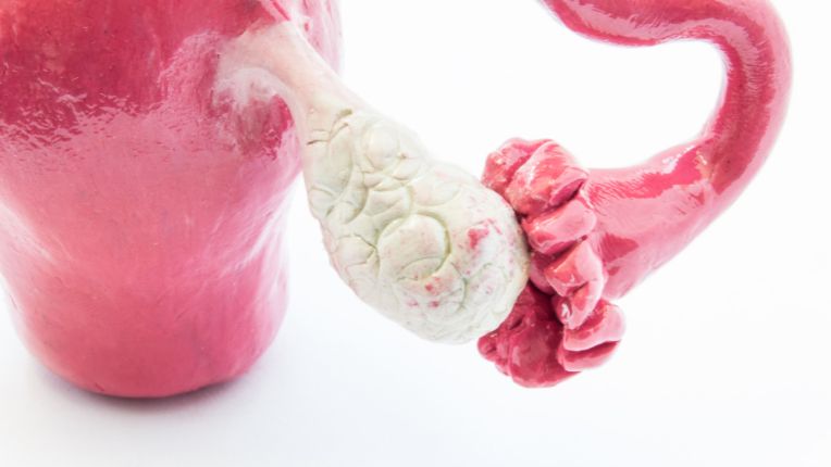 Opération des ovaires par robot à Toulouse. Modèle anatomique en 3D d'un ovaire et d'une trompe de Fallope.