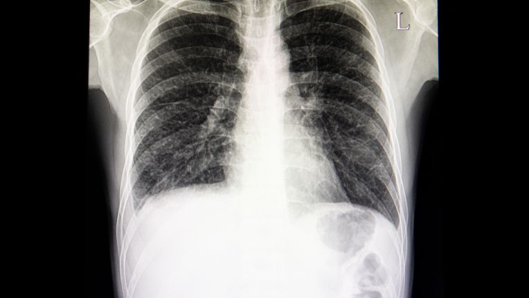 Opération de la plèvre par robot à Toulouse. Vue de la plèvre aux rayons X. Ici un épanchement pleural, accumulation de liquide dans la cavité pleurale.