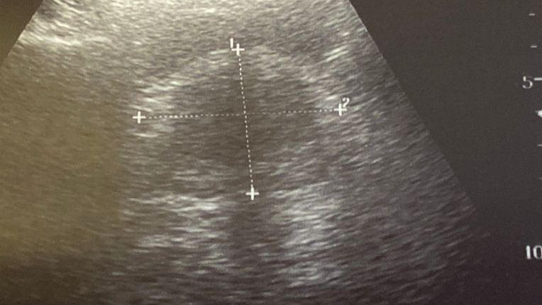 Opération de la prostate par robot à Brest. Echographie de la prostate.