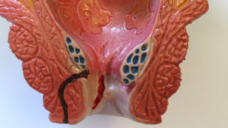 Opération du rectum par robot à Brest. Modèle anatomique de rectum, comprenant la fil du côlon en haut, le rectum et l'anus.