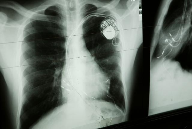 Pacemaker : pose, fonctionnement et complications | Elsan