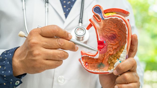 Cancer de l'estomac : un médecin pointe avec son stylet un modèle qui représente l'intérieur d'un estomac.