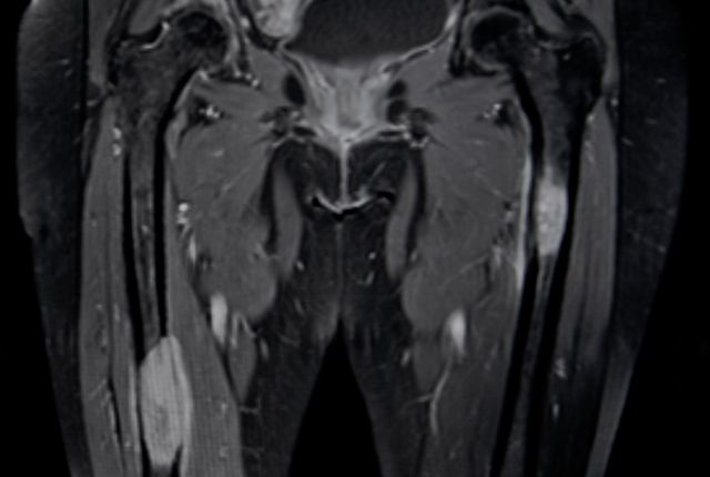 Quelles sont les métastases du cancer de la vessie ? Image en noir et blanc d'une IRM montrant des tumeurs métastatiques du fémur.