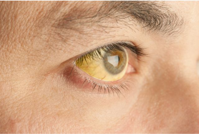 Quels sont les premiers symptômes du cancer du pancréas ? Image d'un oeil dont le blanc a jauni (ictère) signal d'un trouble digestif souvent associé au cancer du pancréas.