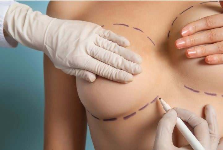 Réduction mammaire : image d'un ou d'une soignante traçant des traits sur la poitrine d'une patiente.