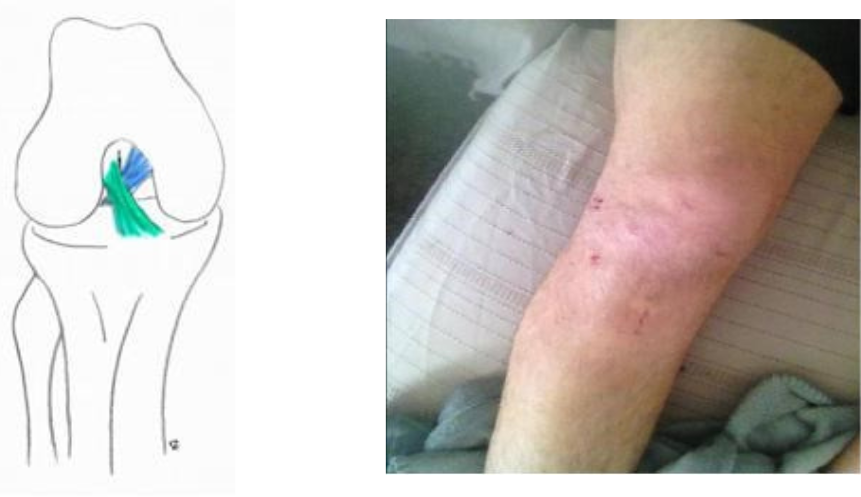 réparation du ligament croisé 