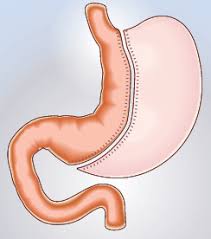 Sleeve gastrectomie - chirurgie bariatrique - CHP Brest - Keraudren