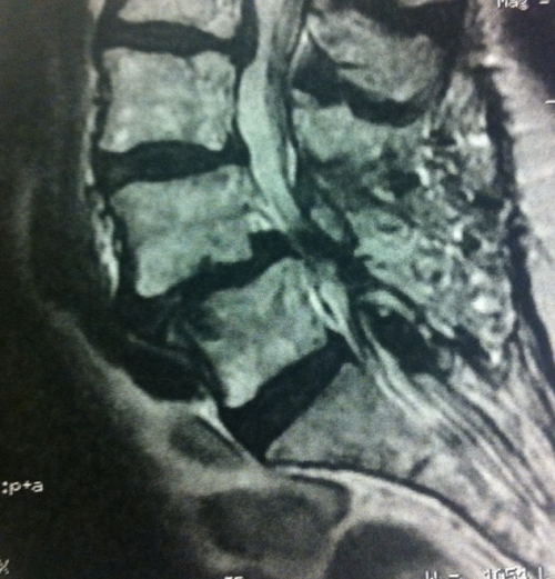 spondylolisthesis-lombaire
