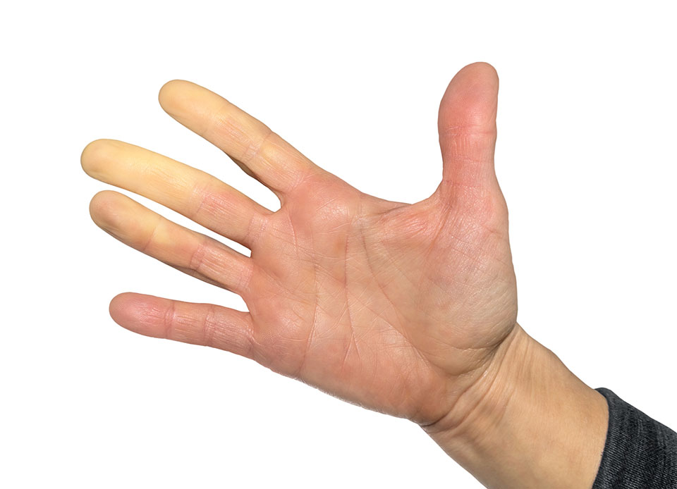 Produit 46 : Traitement Naturel Maladie De Raynaud Traitement naturel maladie de raynaud