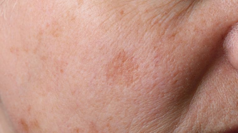 Quels sont les différents types de cancer de la peau ? Image d'une tache lentigine sur le visage d'une femme âgée qui peut se révéler être un mélanome de Dubreuilh.