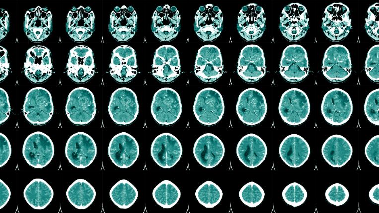 Vaccin méningite à méningocoques Marseille. Série d'images de scanner du cerveau d'un homme.