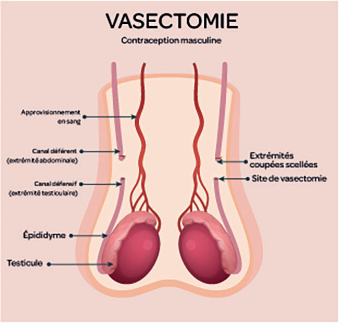 vasectomie