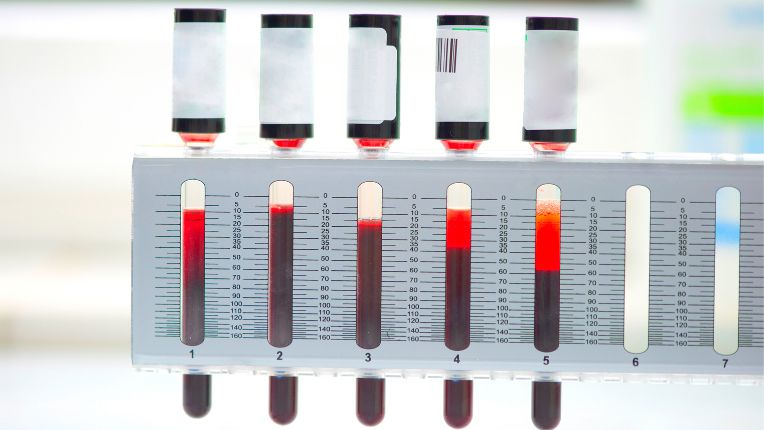 Vitesse de sédimentation : image de tubes de laboratoire dans lesquels les globules rouges du sang sont mesurés.
