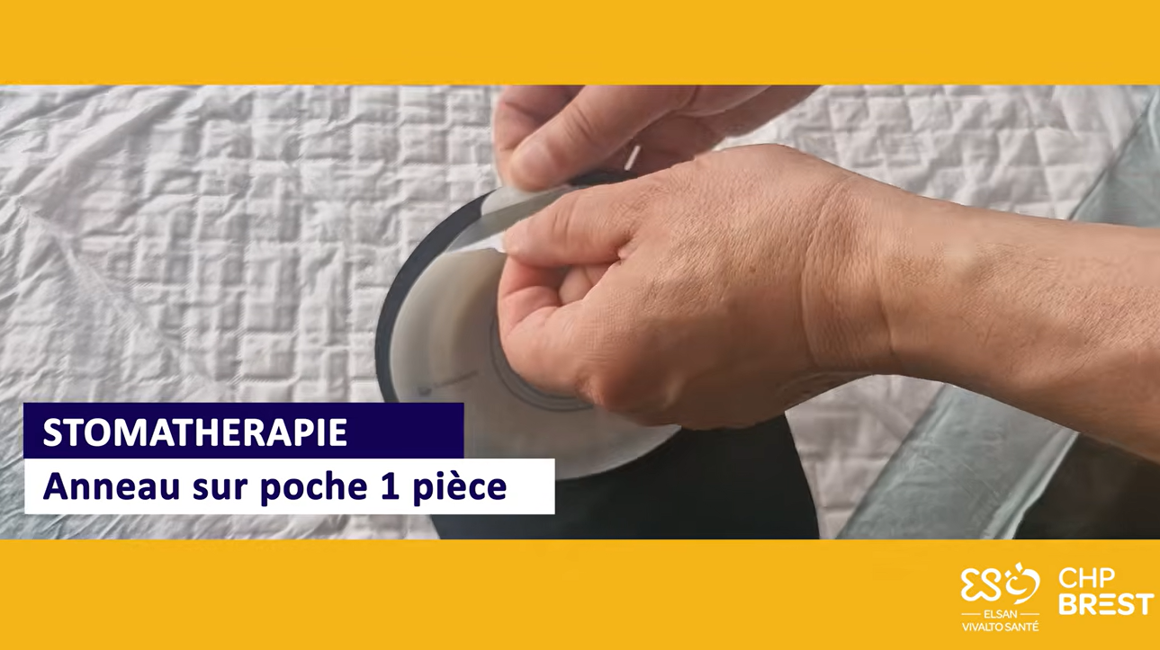 Tutoriel - Soins de stomathérapie - Anneau sur poche 1 pièce - CHP Brest
