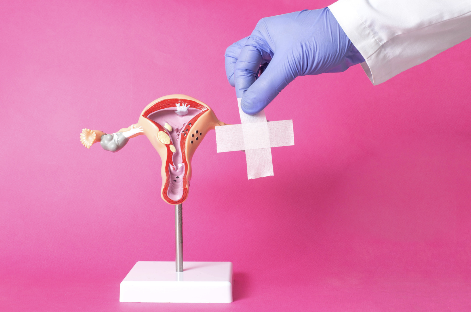 Endométriose superficielle