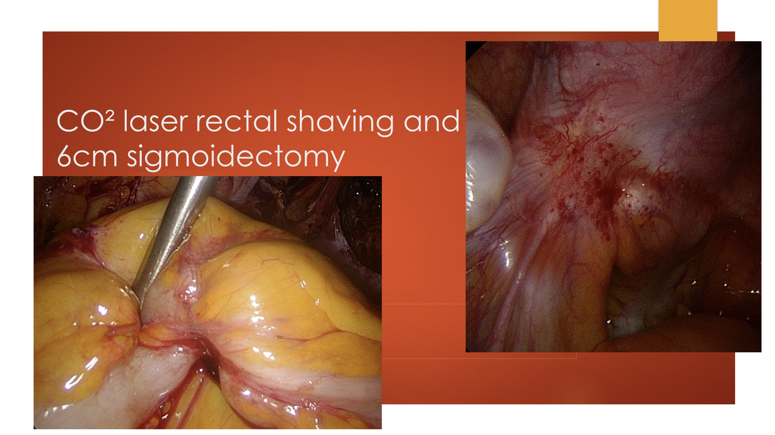 Endométriose profonde sigmoïdienne