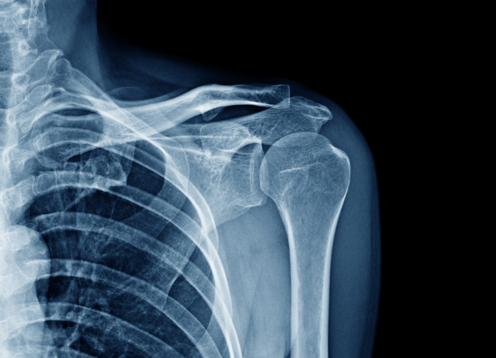 Illustration Fracture de la Clavicule