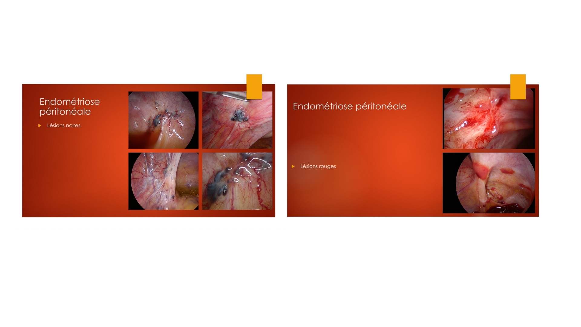 L’endométriose superficielle